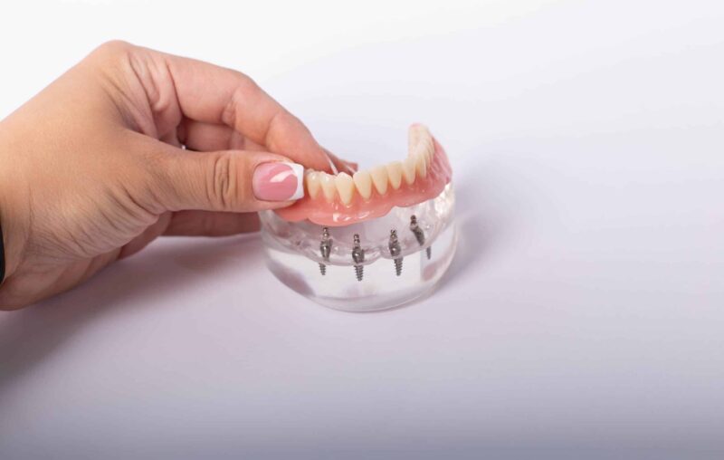 Implant-Supported Dentures in Mishawaka, Dentures, Dental Implants