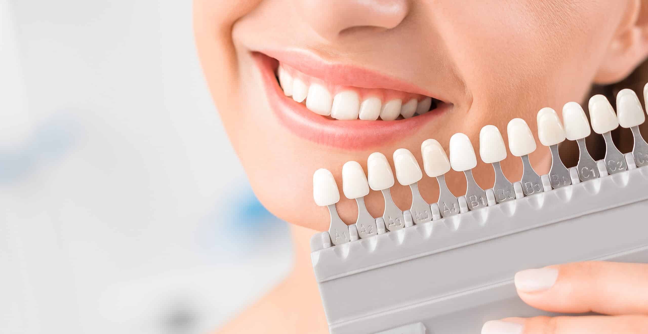 Beautiful smile and white teeth of a young woman after visiting Mishikawa cosmetic dentist